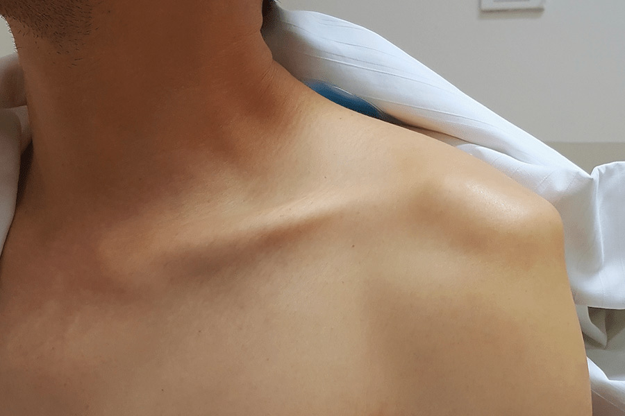 Know about Shoulder Dislocation and it's Symptoms and causes