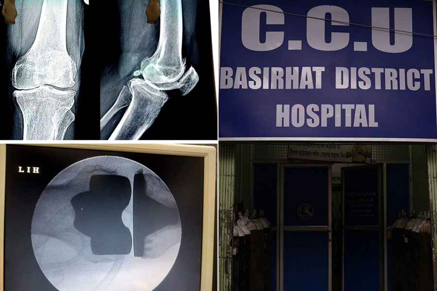 First knee replacement in Basirhat District Hospital