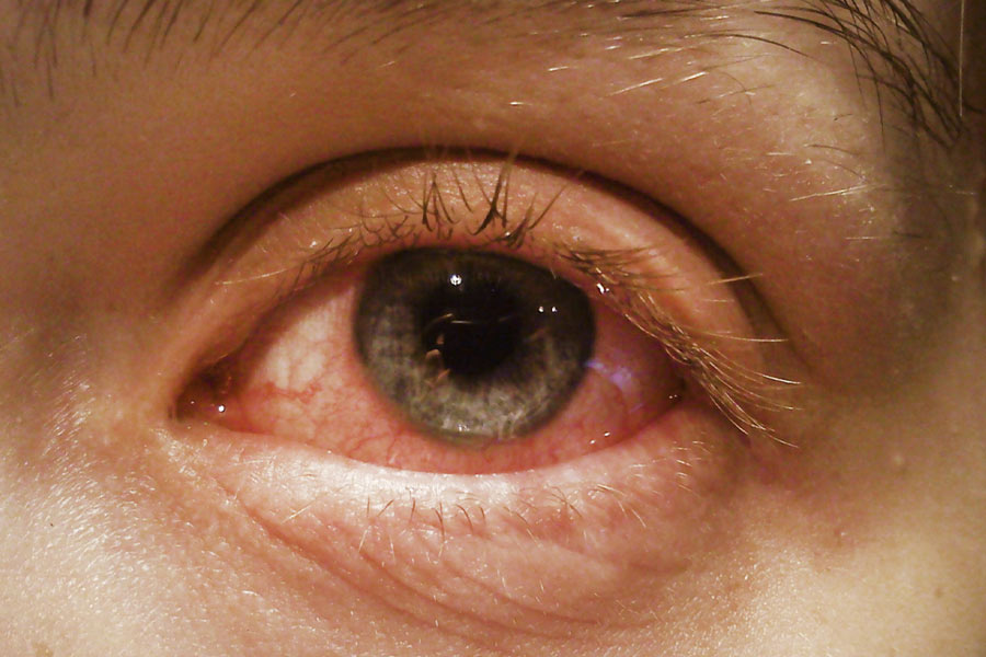 As the rainy season begins Conjunctivitis are increasing, Know How to survive
