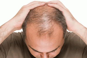 Mass Hair Loss In 3 Maharashtra Villages and Sparks Panic