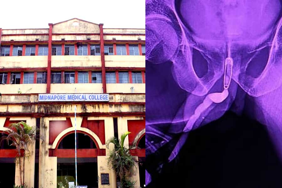 Midnapore Medical College: Doctors Operate on Rare Patient After Safety Pin Gets Stuck in Bladder's Urethra, Critically