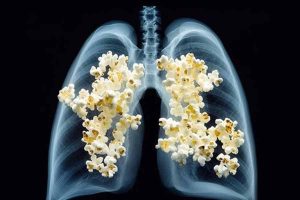 Here are symptoms, causes of Popcorn Lungs
