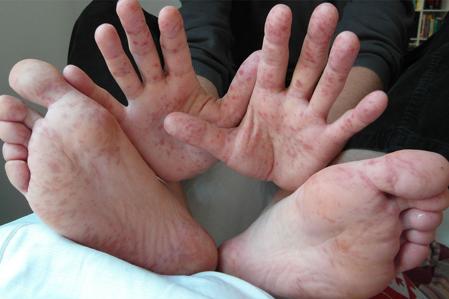 Kids are suffering from fever and rashes due to heat wave